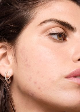 er-det-en-sammenheng-mellom-meieriprodukter-og-uren hud