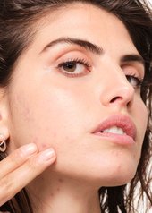 kan-mat-forårsake-akne